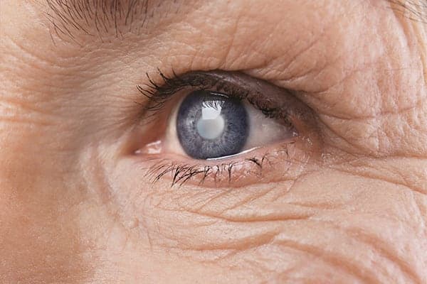 symptome cataracte oeil symptome def centre ophtalmologie popp15 centre ophtalmologique pathologies oeil et paupieres paris 15