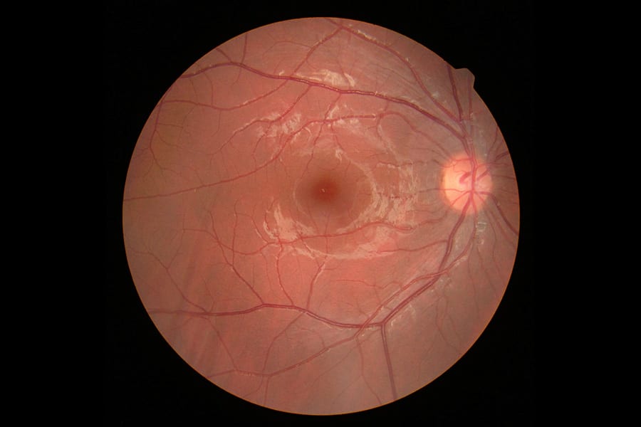 occlusion veineuse retinienne symptomes causes centre ophtalmologie popp15 centre ophtalmologique pathologies oeil et paupieres paris 15