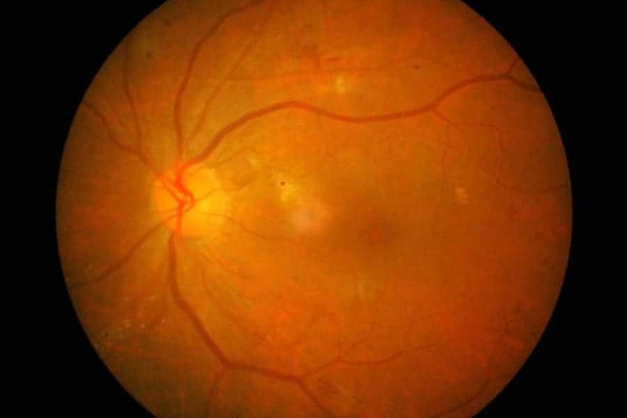 retinopathie diabetique symptomes traitement stades centre ophtalmologie popp15 centre ophtalmologique pathologies oeil et paupieres paris 15